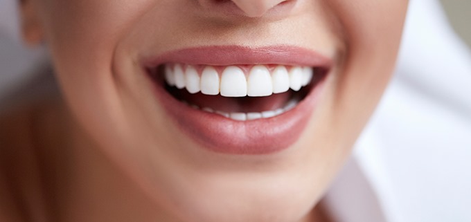 Diseño de sonrisa